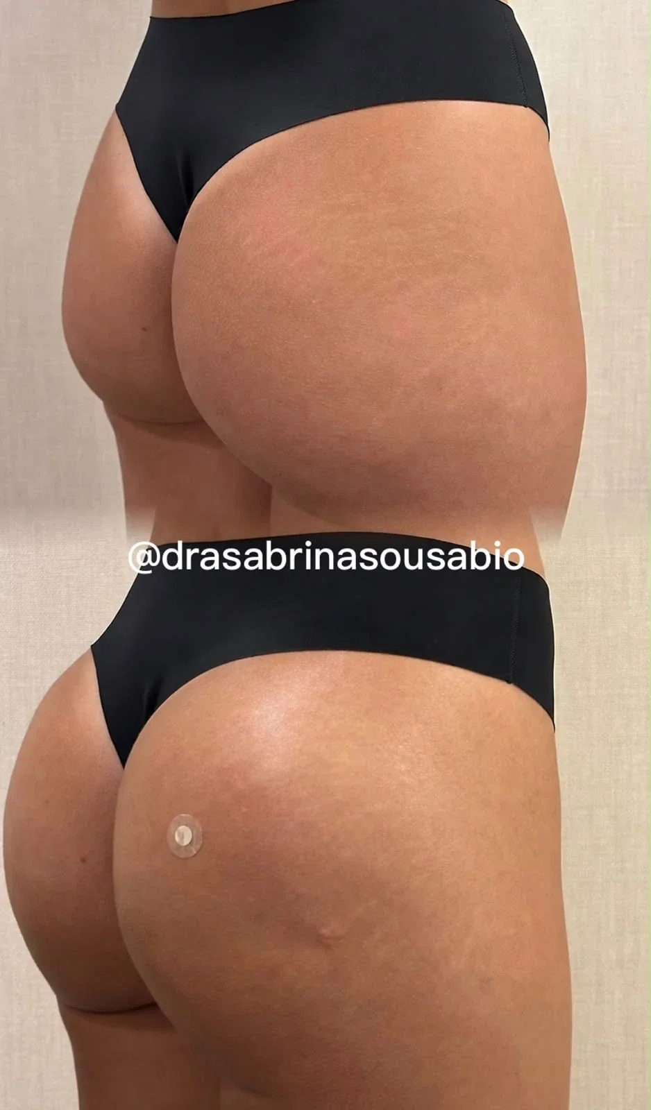 Antes e depois de harmonização glútea no Rio de Janeiro, caso 05, vista posterolateral. Resultado natural com a Dra. Sabrina Sousa