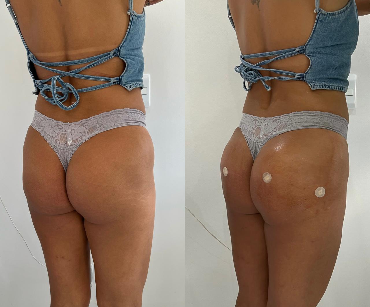 Antes e depois de harmonização glútea no Rio de Janeiro, caso 10, vista posterior. Resultado natural com a Dra. Sabrina Sousa
